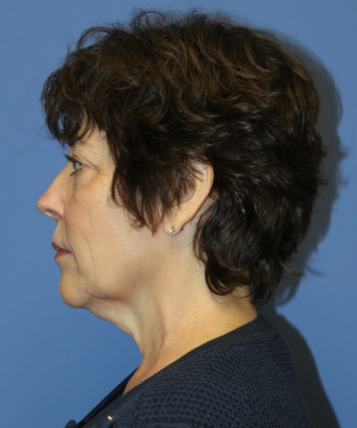 Facelift, Browlift, Lip Augmentation, Laser Skin Resurfacing 4818 – Click HERE for more views before photo. Individual results may vary.