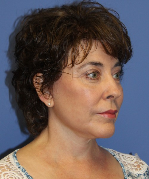 Facelift, Browlift, Lip Augmentation, Laser Skin Resurfacing 4818 – Click HERE for more views after photo. Individual results may vary.