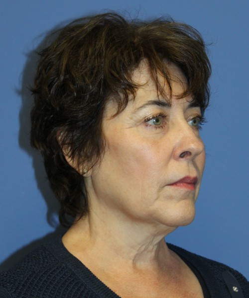 Facelift, Browlift, Lip Augmentation, Laser Skin Resurfacing 4818 – Click HERE for more views before photo. Individual results may vary.