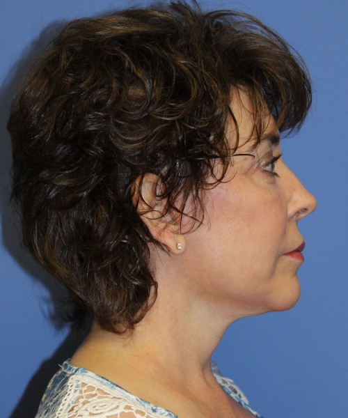 Facelift, Browlift, Lip Augmentation, Laser Skin Resurfacing 4818 – Click HERE for more views after photo. Individual results may vary.