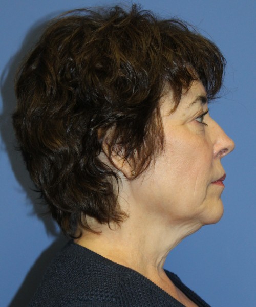 Facelift, Browlift, Lip Augmentation, Laser Skin Resurfacing 4818 – Click HERE for more views before photo. Individual results may vary.