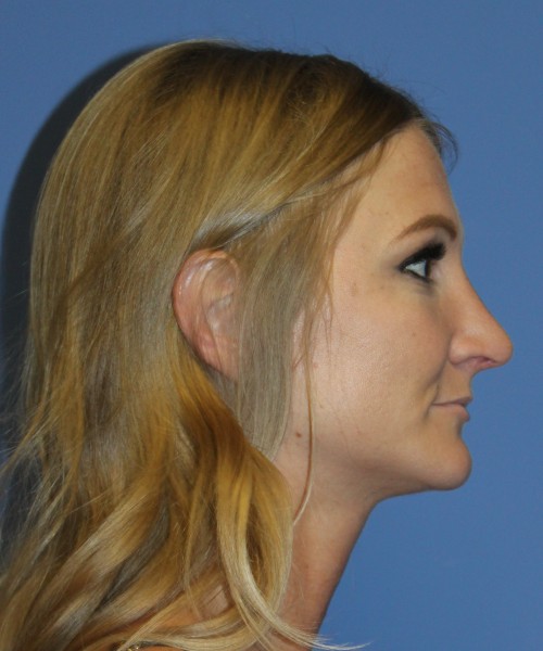 Rhinoplasty 4829 – Click HERE for more views after photo. Individual results may vary.