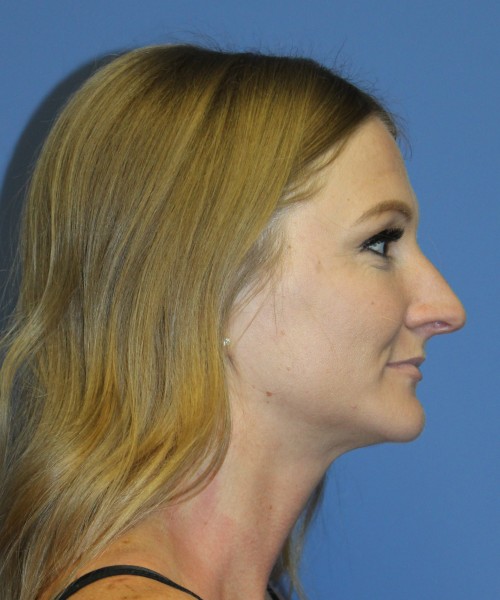 Rhinoplasty 4829 – Click HERE for more views before photo. Individual results may vary.