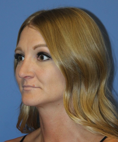 Rhinoplasty 4829 – Click HERE for more views after photo. Individual results may vary.