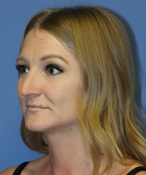 Rhinoplasty 4829 – Click HERE for more views before photo. Individual results may vary.