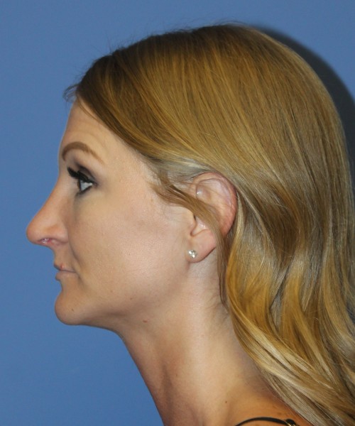 Rhinoplasty 4829 – Click HERE for more views after photo. Individual results may vary.