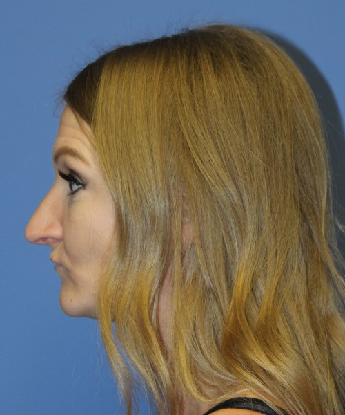 Rhinoplasty 4829 – Click HERE for more views before photo. Individual results may vary.
