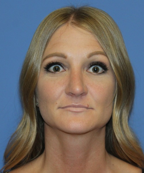 Rhinoplasty 4829 – Click HERE for more views after photo. Individual results may vary.