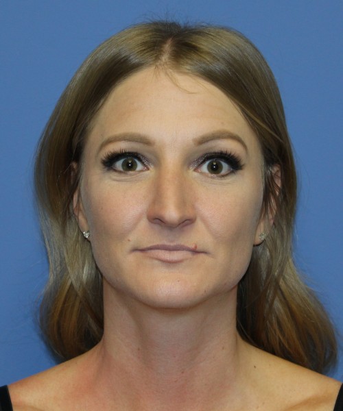 Rhinoplasty 4829 – Click HERE for more views before photo. Individual results may vary.