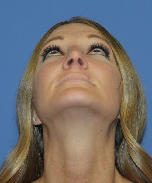 Rhinoplasty 4829 – Click HERE for more views after photo. Individual results may vary.