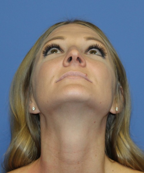 Rhinoplasty 4829 – Click HERE for more views before photo. Individual results may vary.