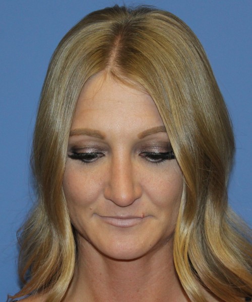 Rhinoplasty 4829 – Click HERE for more views after photo. Individual results may vary.