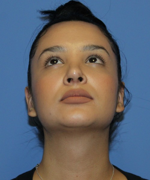 Revision Rhinoplasty 4860 – Click HERE for more views after photo. Individual results may vary.