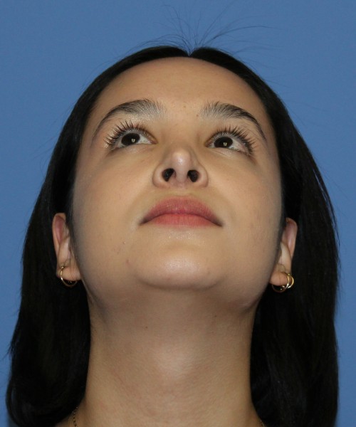 Revision Rhinoplasty 4860 – Click HERE for more views before photo. Individual results may vary.