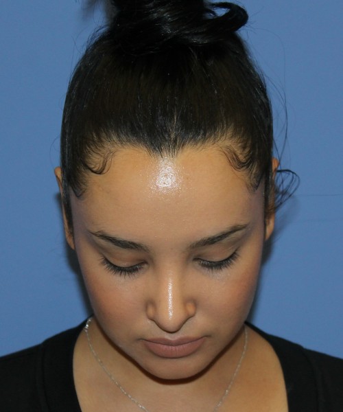 Revision Rhinoplasty 4860 – Click HERE for more views after photo. Individual results may vary.
