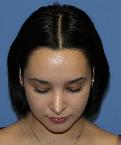Revision Rhinoplasty 4860 – Click HERE for more views before photo. Individual results may vary.