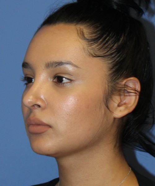 Revision Rhinoplasty 4860 – Click HERE for more views after photo. Individual results may vary.