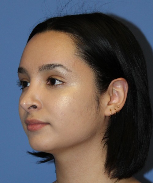 Revision Rhinoplasty 4860 – Click HERE for more views before photo. Individual results may vary.