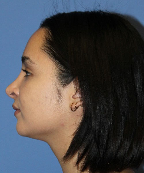 Revision Rhinoplasty 4860 – Click HERE for more views before photo. Individual results may vary.