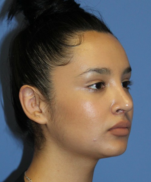 Revision Rhinoplasty 4860 – Click HERE for more views after photo. Individual results may vary.