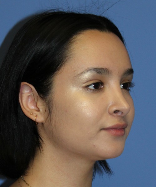 Revision Rhinoplasty 4860 – Click HERE for more views before photo. Individual results may vary.