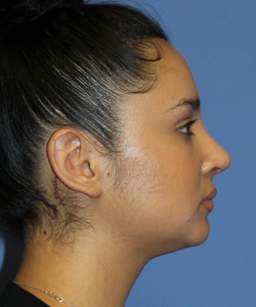 Revision Rhinoplasty 4860 – Click HERE for more views after photo. Individual results may vary.