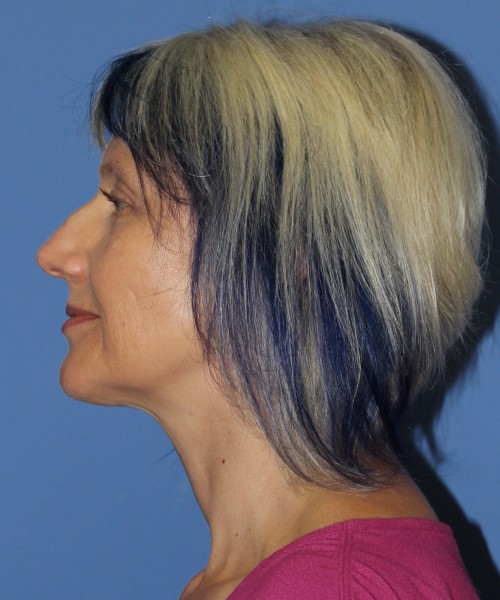 Facelift, Browlift, Lip Augmentation 4875 – Click HERE for more views before photo. Individual results may vary.