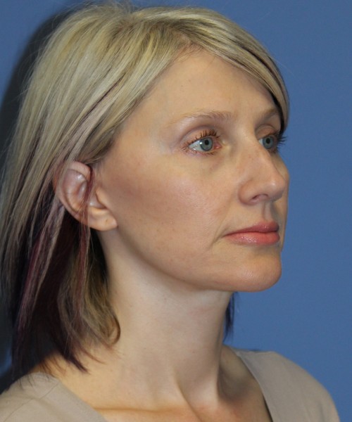 Facelift, Browlift, Lip Augmentation 4875 – Click HERE for more views after photo. Individual results may vary.