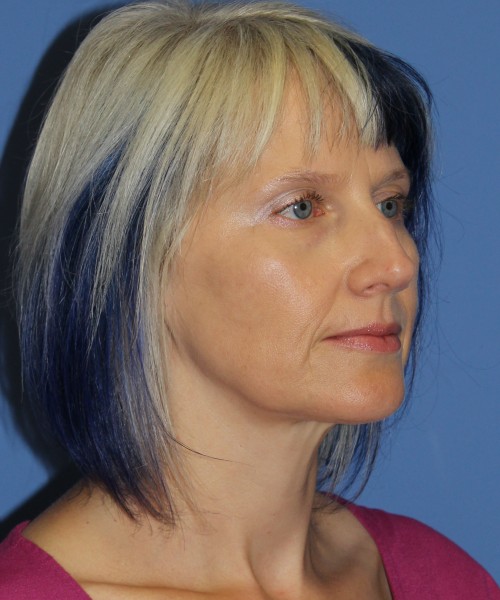 Facelift, Browlift, Lip Augmentation 4875 – Click HERE for more views before photo. Individual results may vary.