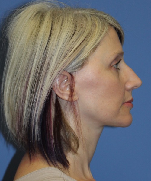 Facelift, Browlift, Lip Augmentation 4875 – Click HERE for more views after photo. Individual results may vary.