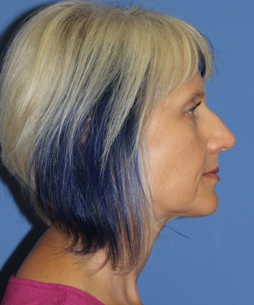 Facelift, Browlift, Lip Augmentation 4875 – Click HERE for more views before photo. Individual results may vary.