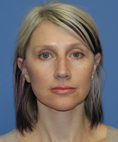 Facelift, Browlift, Lip Augmentation 4875 – Click HERE for more views after photo. Individual results may vary.