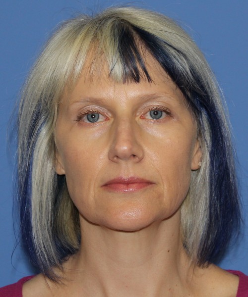 Facelift, Browlift, Lip Augmentation 4875 – Click HERE for more views before photo. Individual results may vary.