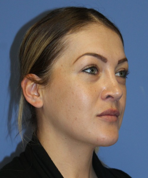 Rhinoplasty, Submental Liposuction 4893 – Click HERE for more views after photo. Individual results may vary.