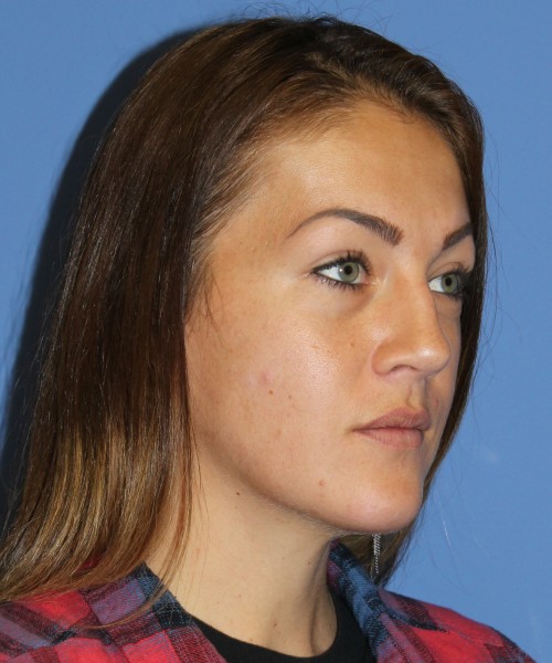Rhinoplasty, Submental Liposuction 4893 – Click HERE for more views before photo. Individual results may vary.