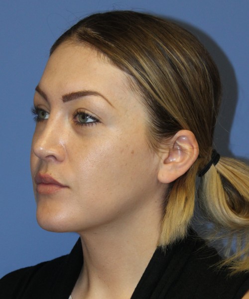 Rhinoplasty, Submental Liposuction 4893 – Click HERE for more views after photo. Individual results may vary.
