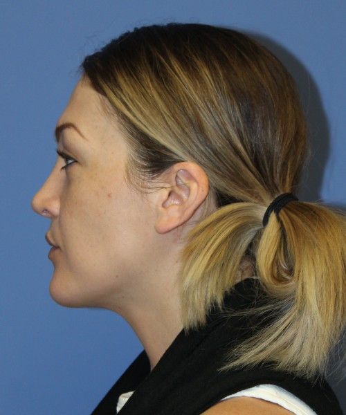 Rhinoplasty, Submental Liposuction 4893 – Click HERE for more views after photo. Individual results may vary.