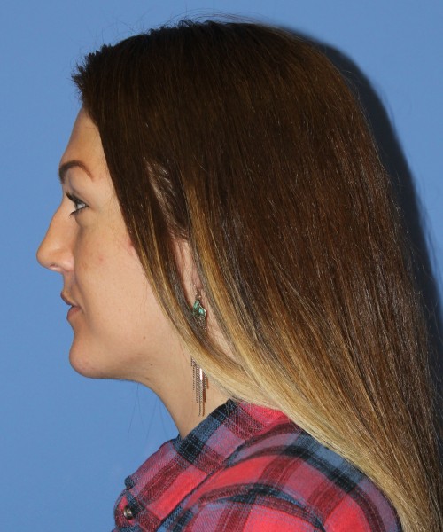 Rhinoplasty, Submental Liposuction 4893 – Click HERE for more views before photo. Individual results may vary.