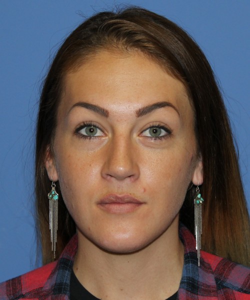 Rhinoplasty, Submental Liposuction 4893 – Click HERE for more views before photo. Individual results may vary.