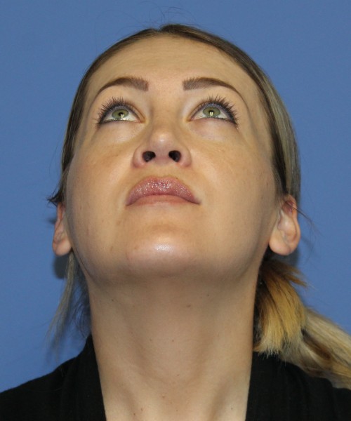 Rhinoplasty, Submental Liposuction 4893 – Click HERE for more views after photo. Individual results may vary.