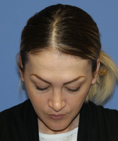 Rhinoplasty, Submental Liposuction 4893 – Click HERE for more views after photo. Individual results may vary.
