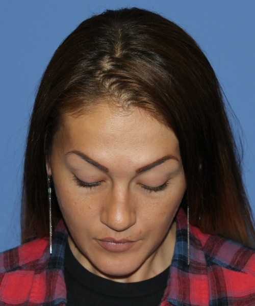 Rhinoplasty, Submental Liposuction 4893 – Click HERE for more views before photo. Individual results may vary.