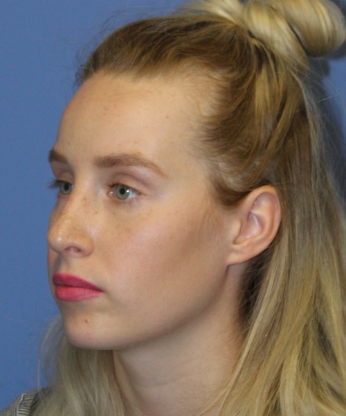 Revision Rhinoplasty 4909 – Click HERE for more views after photo. Individual results may vary.