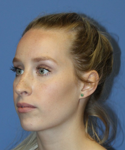 Revision Rhinoplasty 4909 – Click HERE for more views before photo. Individual results may vary.