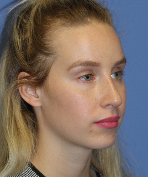Revision Rhinoplasty 4909 – Click HERE for more views after photo. Individual results may vary.