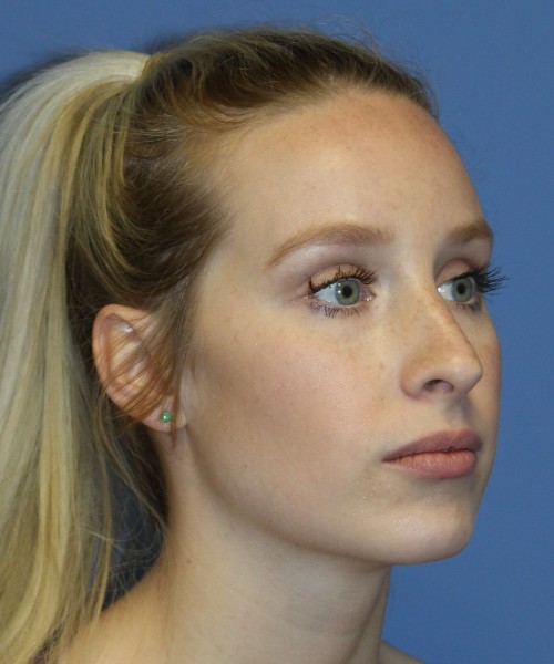 Revision Rhinoplasty 4909 – Click HERE for more views before photo. Individual results may vary.