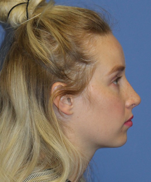 Revision Rhinoplasty 4909 – Click HERE for more views after photo. Individual results may vary.