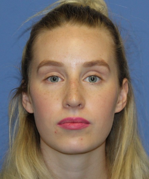 Revision Rhinoplasty 4909 – Click HERE for more views after photo. Individual results may vary.