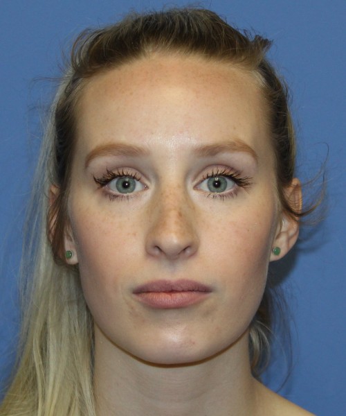 Revision Rhinoplasty 4909 – Click HERE for more views before photo. Individual results may vary.