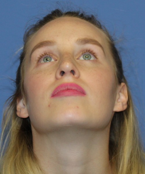Revision Rhinoplasty 4909 – Click HERE for more views after photo. Individual results may vary.